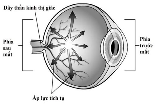Tăng nhãn áp (Glaucoma) 1