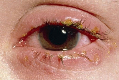 Triệu chứng của đau mắt đỏ 1