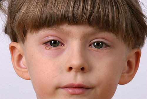 Đau mắt đỏ là bệnh như thế nào? 1